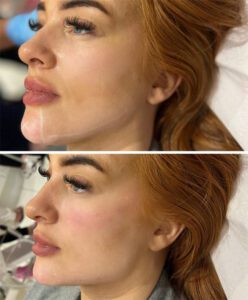 Jaw filler