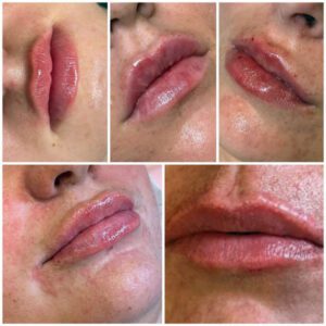 Lip Filler 0.5 ml