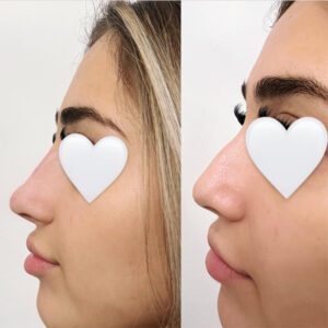 Non-Surgical Rhinoplasty